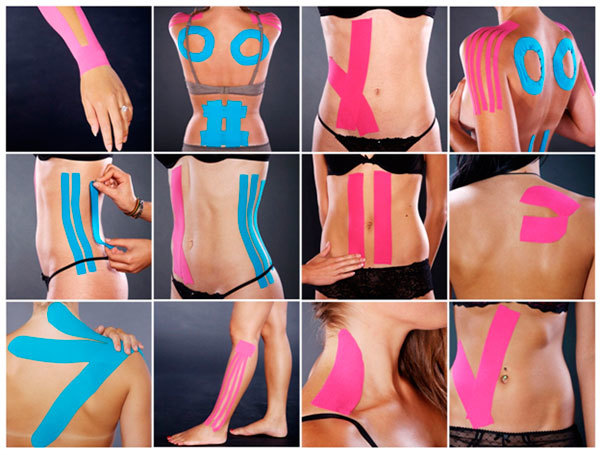 Кинезиотейпирование 